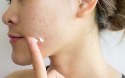 Fighting Acne With a Food Intolerance Test?